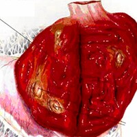 Gastritis hemorrágica ulcerativa